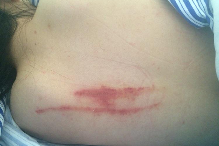 背部擦伤图 背部擦伤图