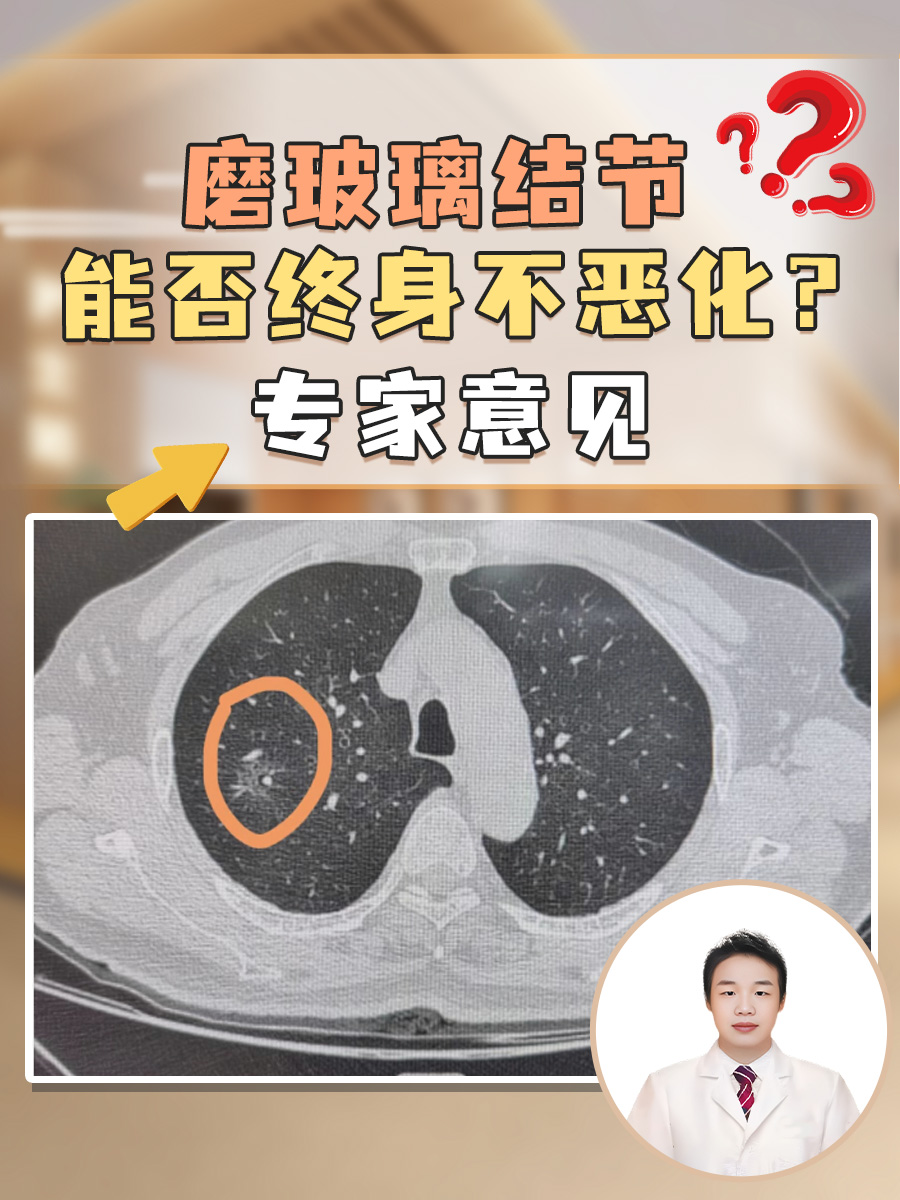 磨玻璃结节能否终身不恶化？专家意见