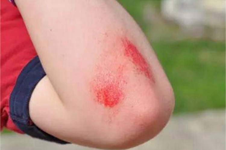 磨压伤胳膊充血图