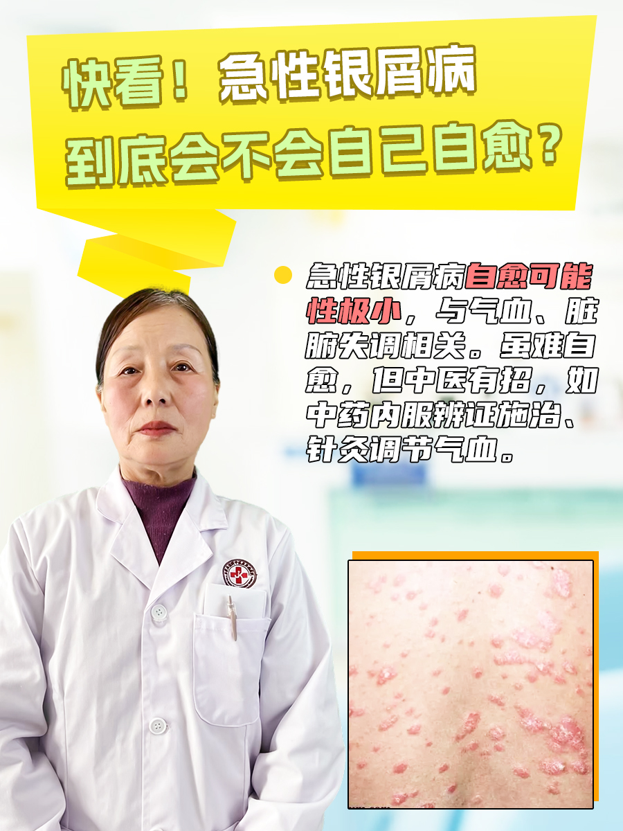 快看!急性银屑病到底会不会自己自愈?