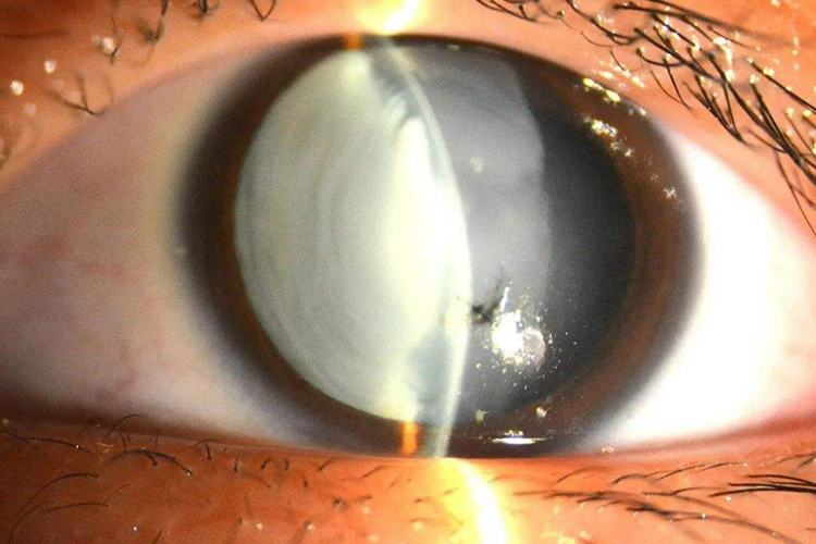 儿童眼球破裂图