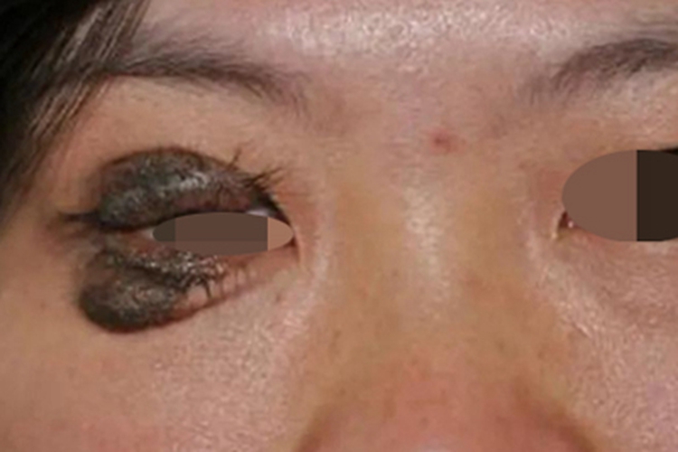 眼睑复合痣变形图 眼睑复合痣变形图