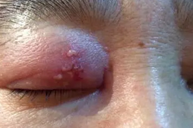 眼角单纯疱疹水疱红肿图