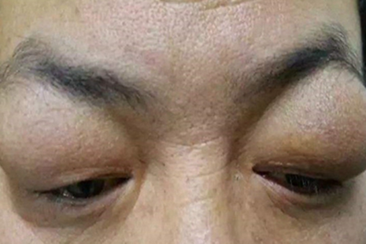 单纯性甲状腺肿眼睑水肿图 单纯性甲状腺肿眼睑水肿图