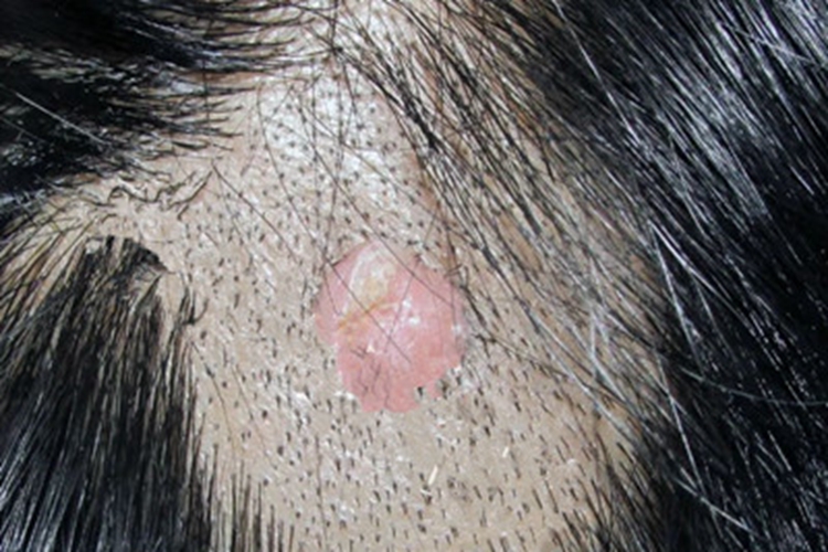 毛囊瘤头皮结节图 毛囊瘤头皮结节图