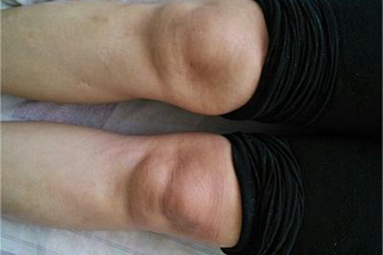 风湿性关节炎膝盖肿胀图 风湿性关节炎膝盖肿胀图