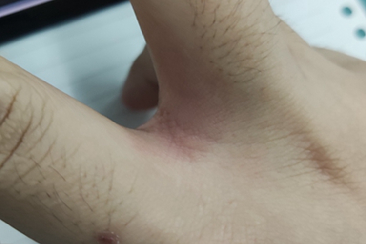 亚急性接触性皮炎手指缝症状图