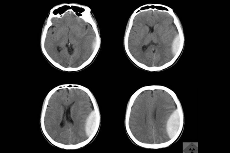 左侧急性硬膜下血肿CT图 左侧急性硬膜下血肿CT图