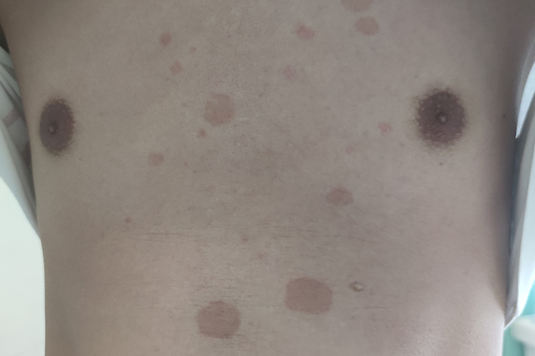 胸口花斑糠疹图