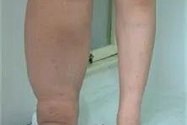 丝虫性淋巴水肿小腿水肿图 丝虫性淋巴水肿小腿水肿图