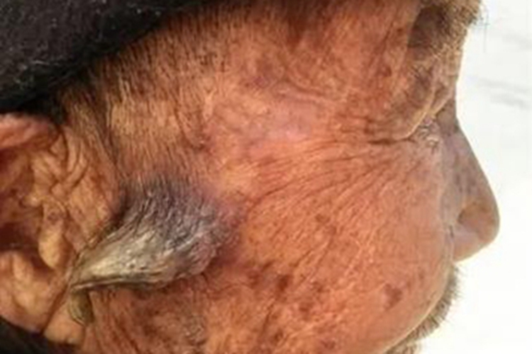 皮角耳周症状图 皮角耳周症状图