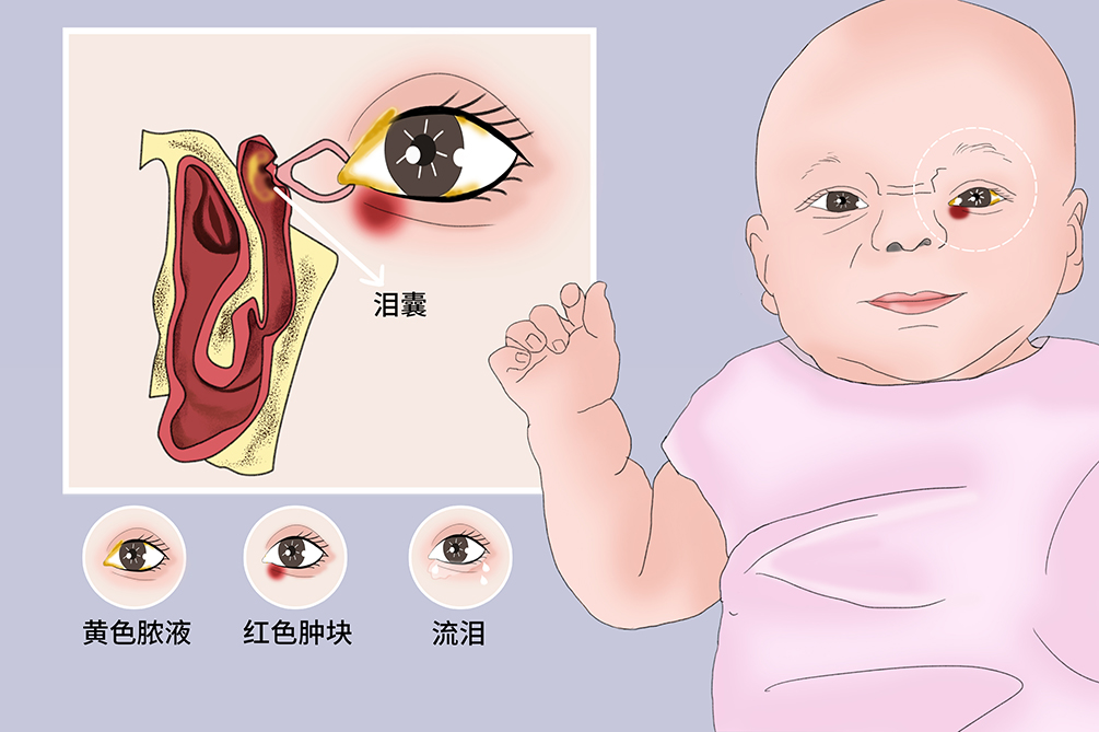 新生宝宝泪囊炎图片图片