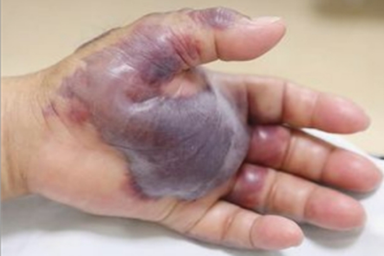 皮肤非典型分枝杆菌病手掌症状图 皮肤非典型分枝杆菌病手掌症状图