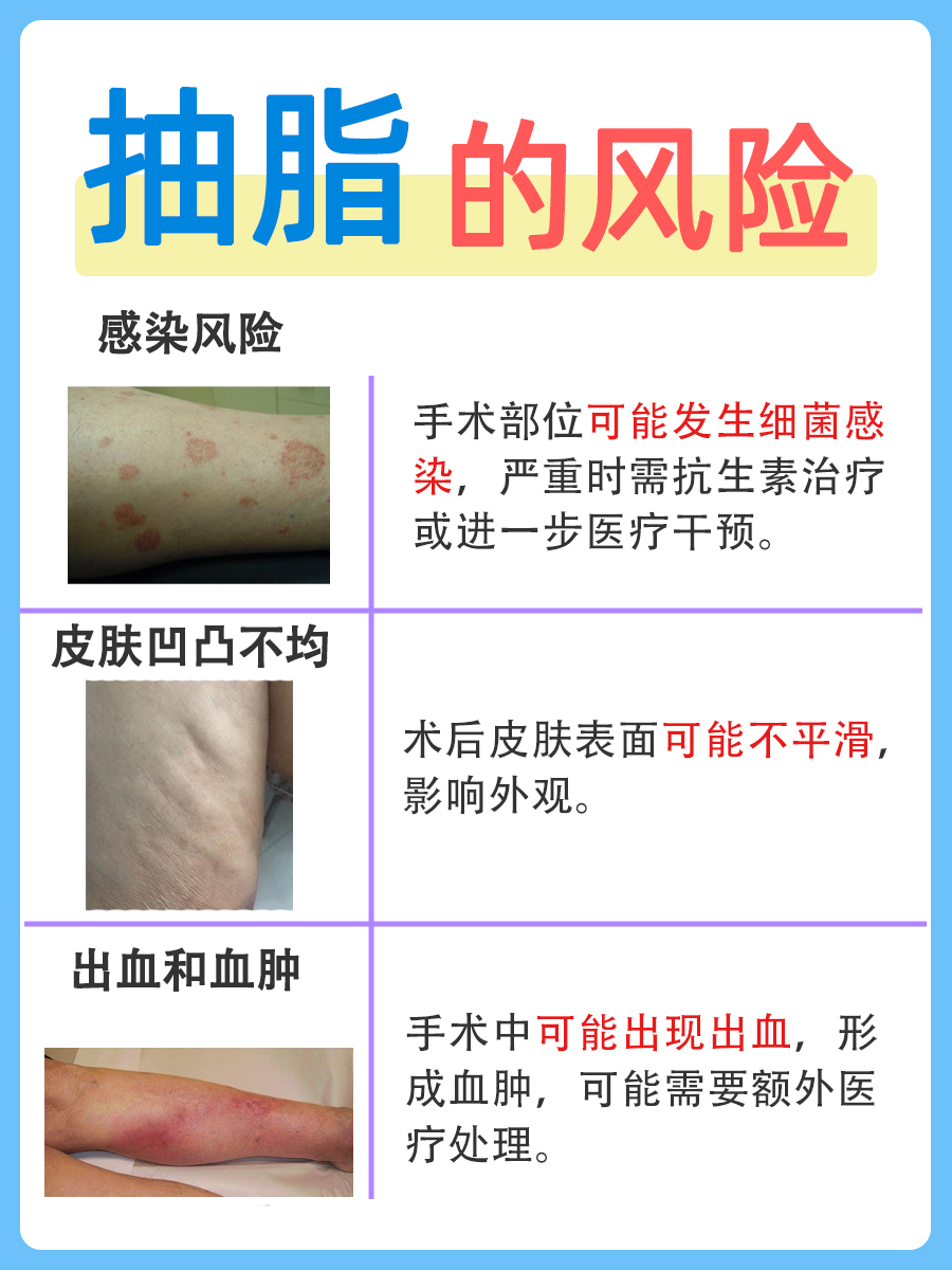 抽脂的风险和后遗症，快来了解！