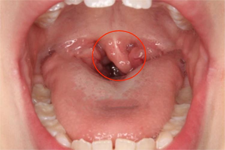 悬雍垂过长症症状图