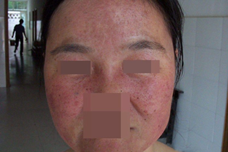 季节性接触性皮炎面部红点图