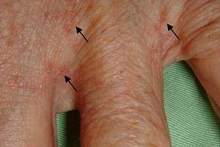 疥疮初期症状图