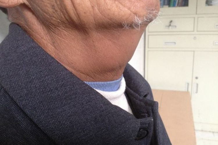 食道癌脖子肿大图