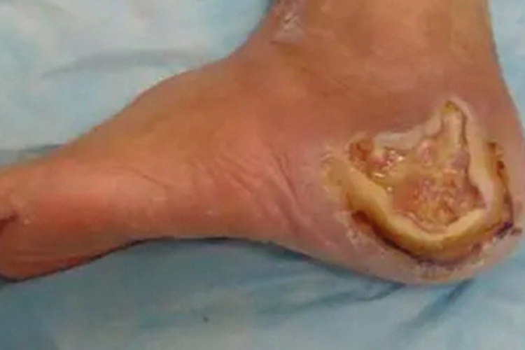 坏疽性臁疮脚后跟症状图