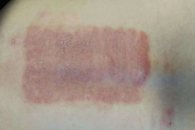 后背接触性皮炎症状图