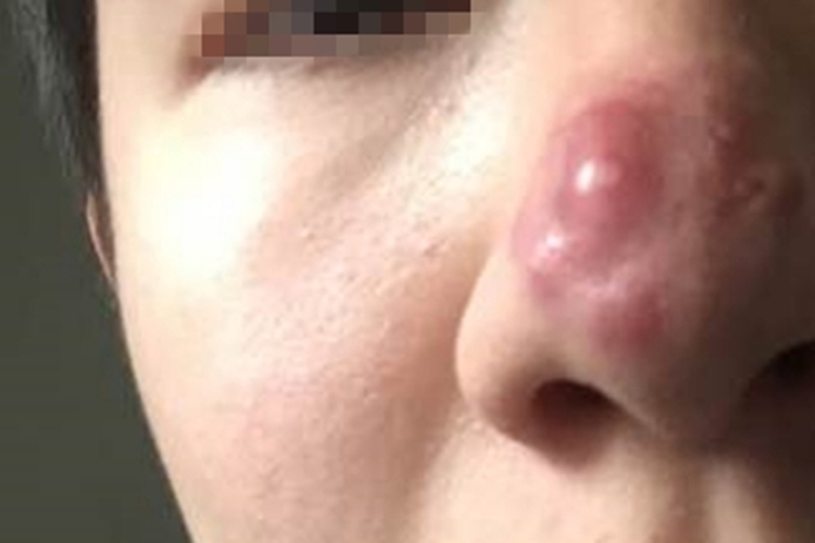 酒糟鼻大疙瘩图