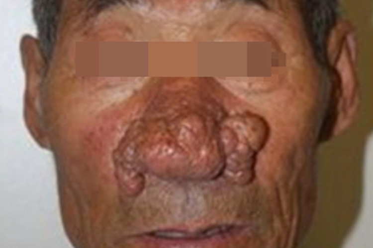 鼻赘型酒糟鼻鼻部肉赘图