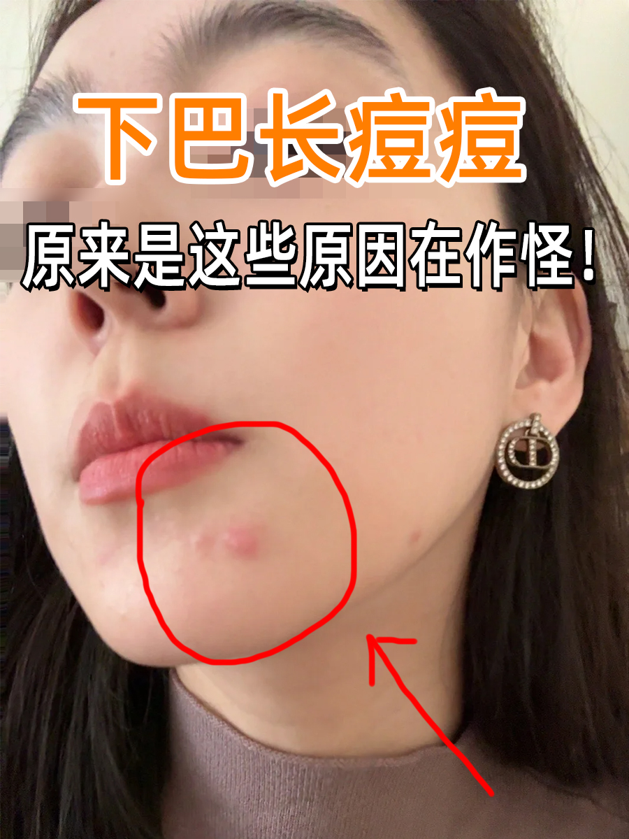 下巴长痘痘,原来是这些原因在作怪!