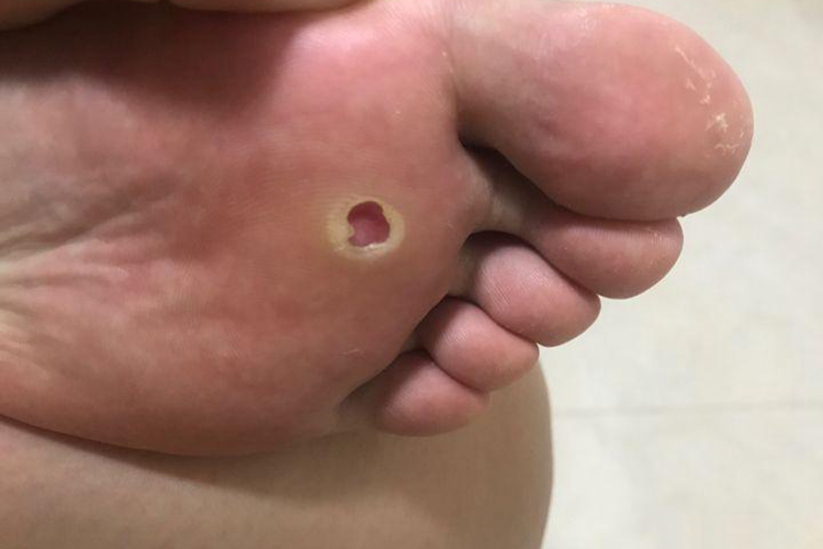 鸡眼冷冻后长肉芽组织图