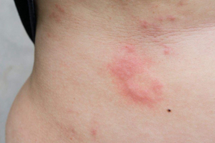 急性单纯性痒疹腹部红肿图
