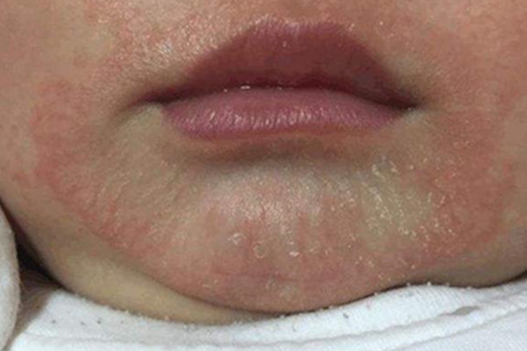 特应性皮炎口周红斑图