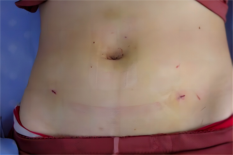 子宫腹腔镜切除恢复后伤口图 子宫腹腔镜切除恢复后伤口图