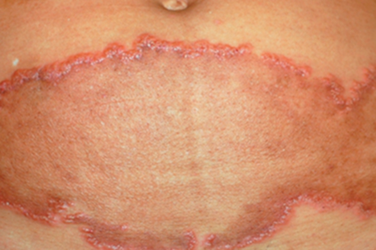 持久性隆起性红斑腹部红斑图 持久性隆起性红斑腹部红斑图
