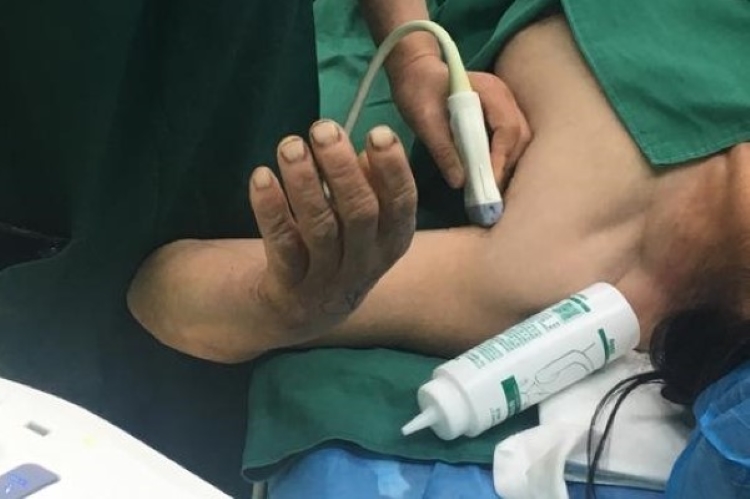 臂丛神经阻滞麻醉注射麻药图 臂丛神经阻滞麻醉注射麻药图