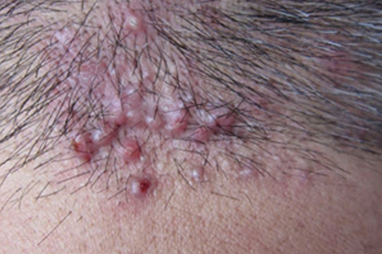 项部瘢痕疙瘩性毛囊炎头皮丘疹图