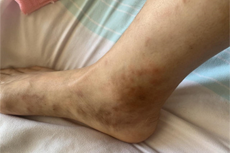 青斑性血管病脚踝斑图