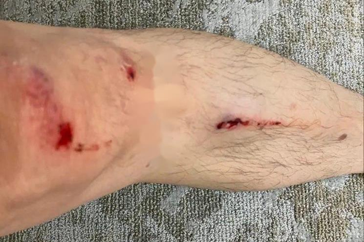 腿摔伤伤口不规则出血图 腿摔伤伤口不规则出血图