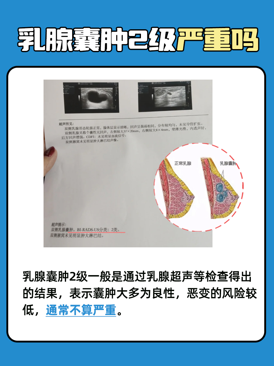 乳腺囊肿2级，严重性与治疗之道