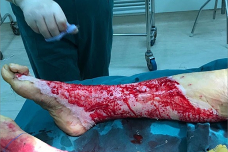 深Ⅱ度烧伤出血图 深Ⅱ度烧伤出血图