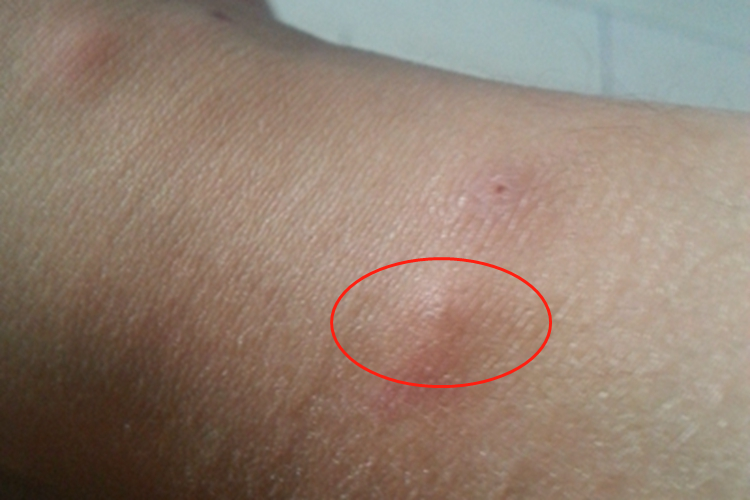 臭虫性皮炎大包图 臭虫性皮炎大包图