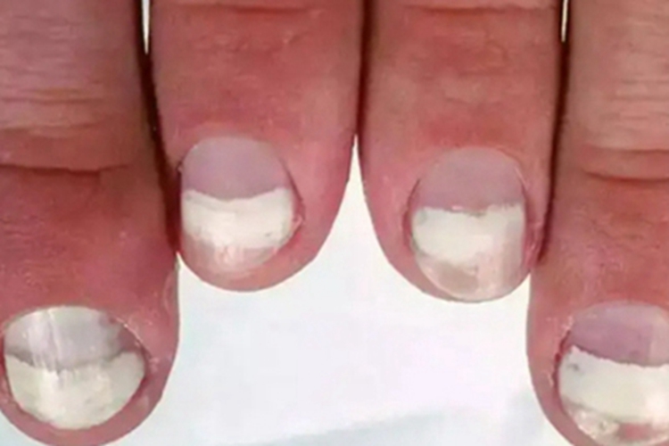 部分白甲手指甲症状图