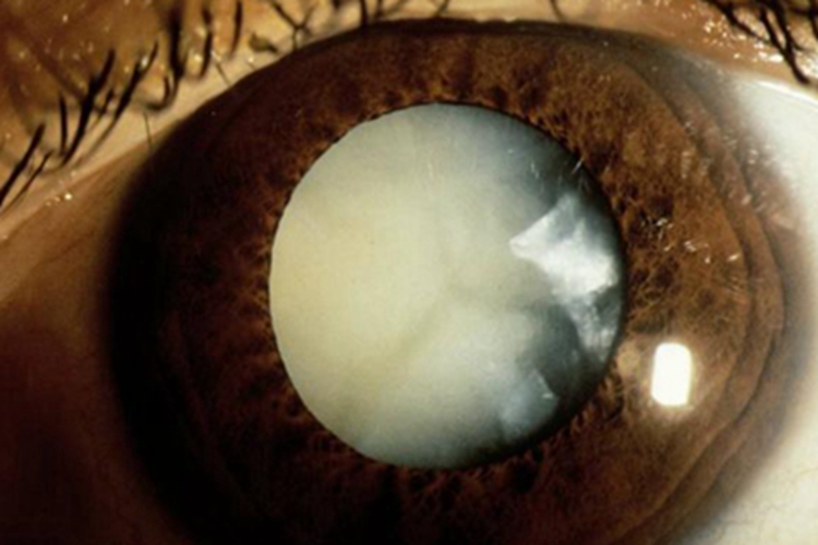 核性白内障白斑图