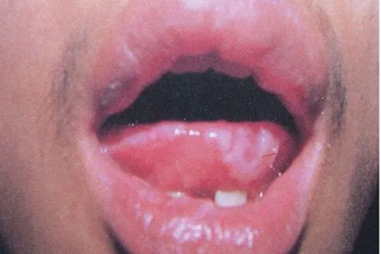 二期口腔梅毒舌尖症状图