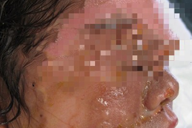 深Ⅱ度烧伤面部水疱图