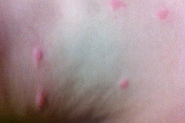 蚊虫叮咬图 蚊虫叮咬图