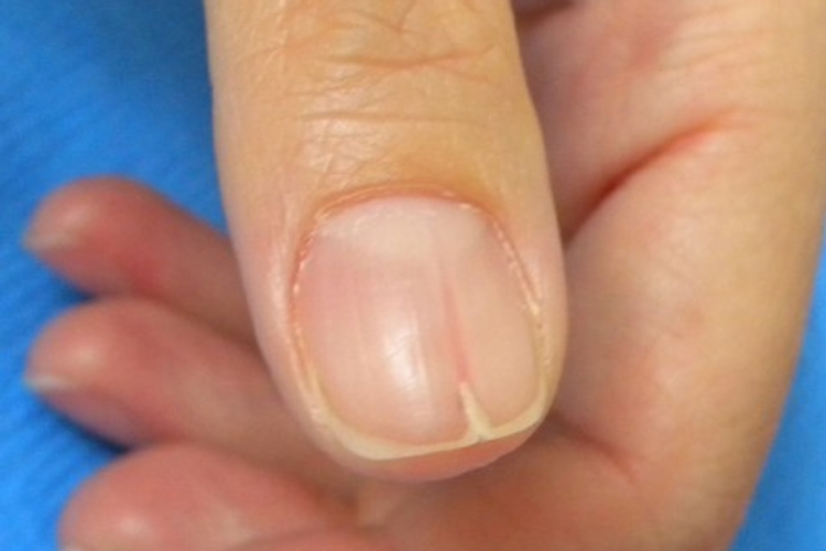 甲乳头状瘤纵行红色条带图