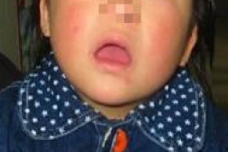 唐氏综合征面部呆滞图