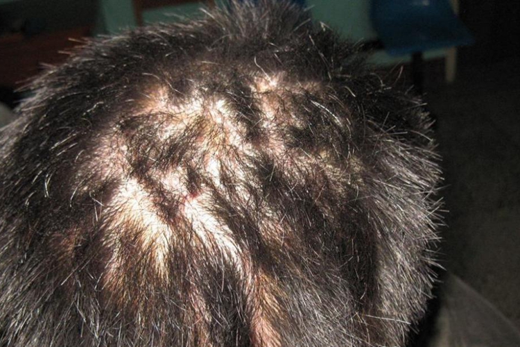 银屑病束状发图