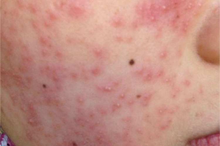 感染型化妆品皮炎面部水疱图
