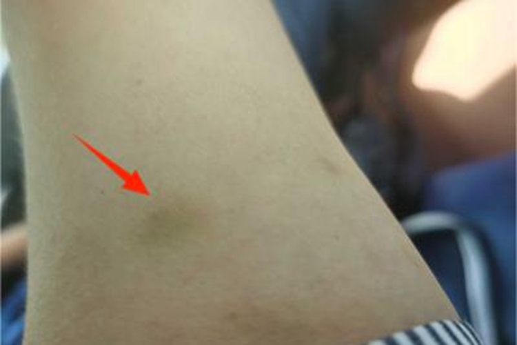 外伤胳膊有块淤青图