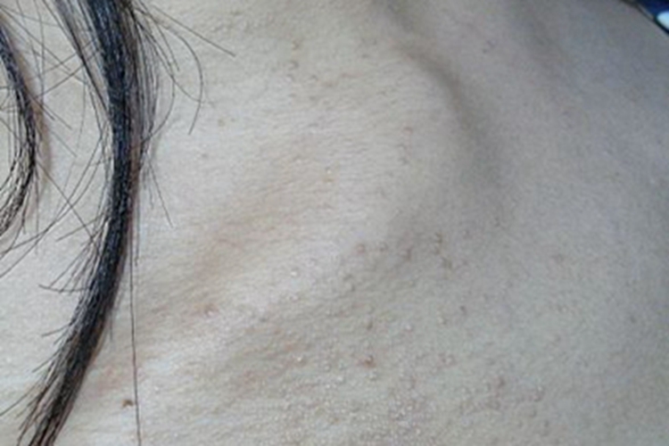 汗管瘤胸部密集小疙瘩图